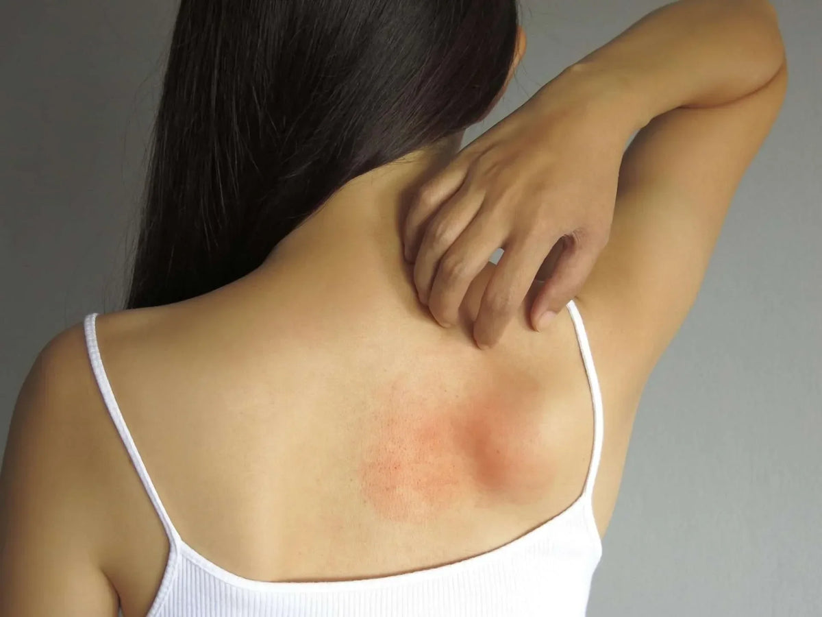 La dermatite atopica: una malattia infiammatoria da trattare con attenzione
